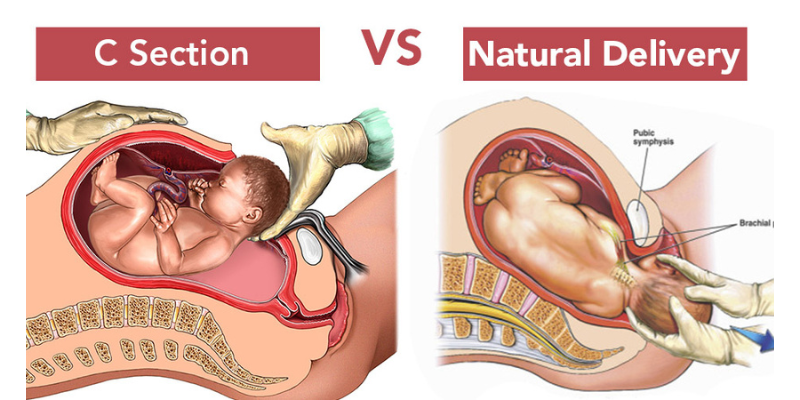 c-section-vs-normal-delivery c-section-vs-normal-delivery